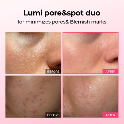 [TikTok Bestseller] Lumi Pore & Spot Care Duo