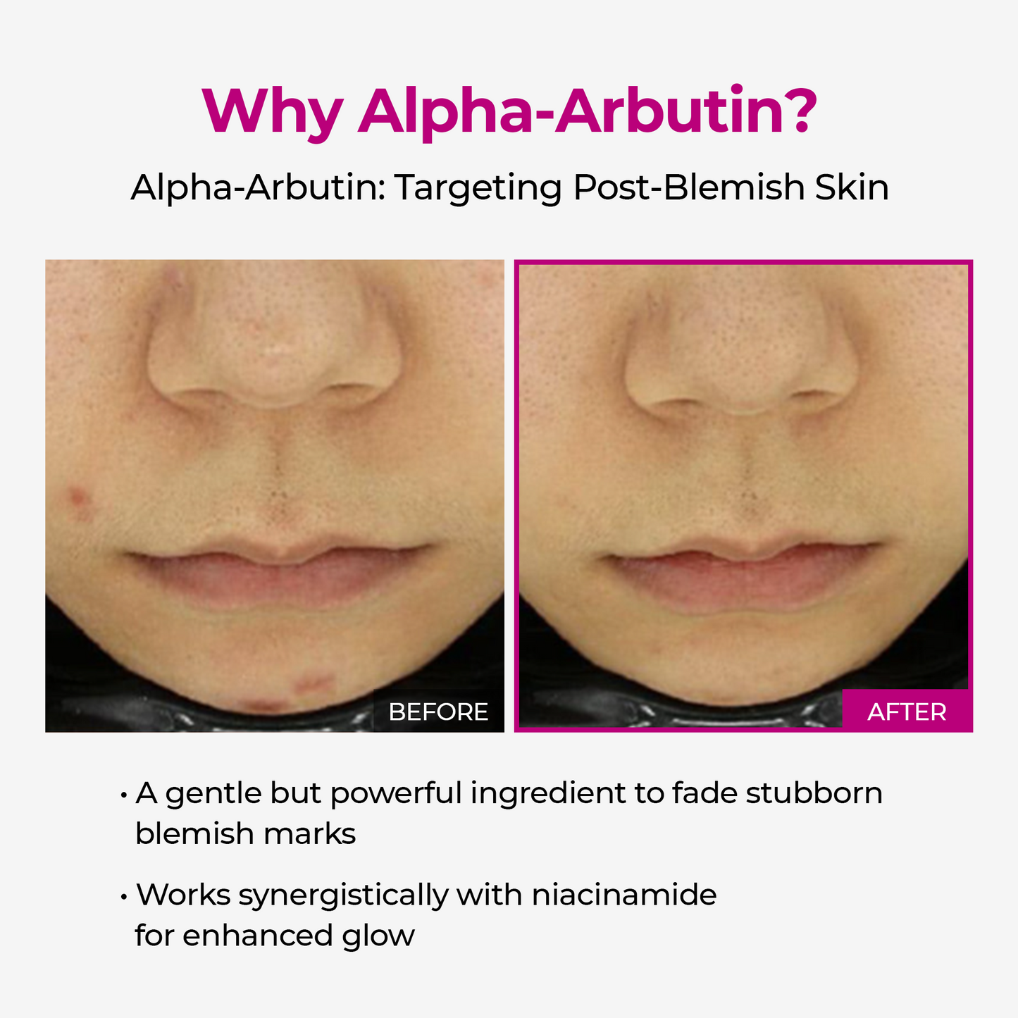 [TikTok Bestseller] Lumi Pore & Spot Care Duo